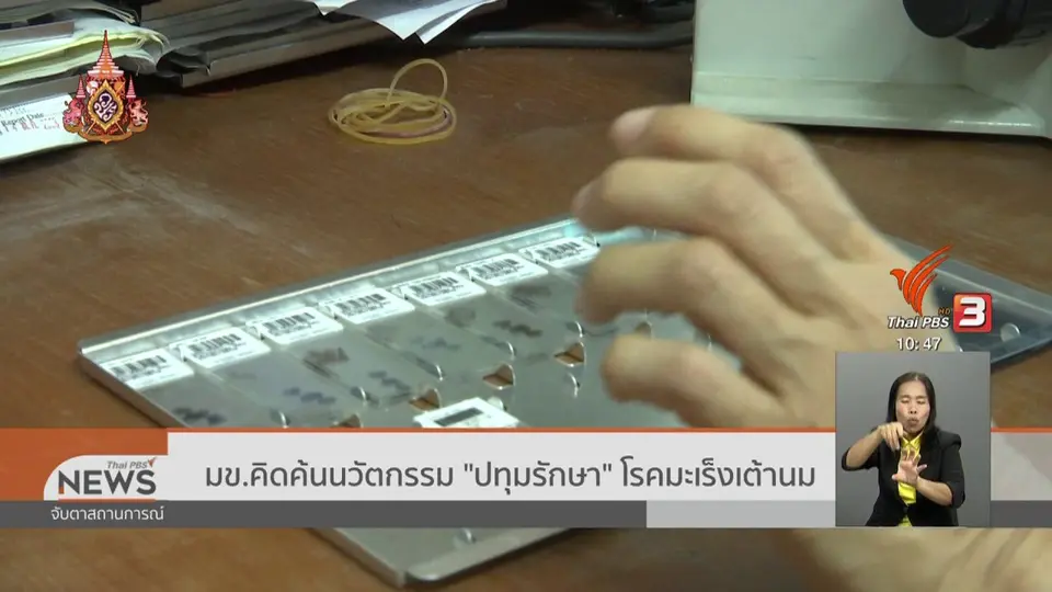 มข.คิดค้นนวัตกรรม "ปทุมรักษา" โรคมะเร็งเต้านม