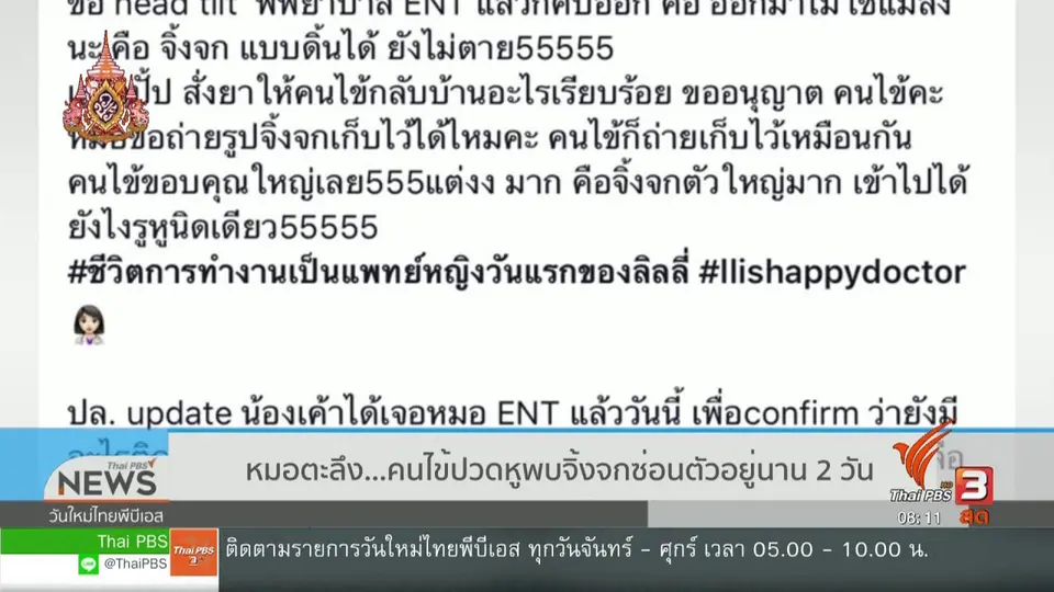 จับตาข่าวเด่น : หมอตะลึง คนไข้ปวดหู พบจิ้งจกซ่อนตัวอยู่นาน 2 วัน