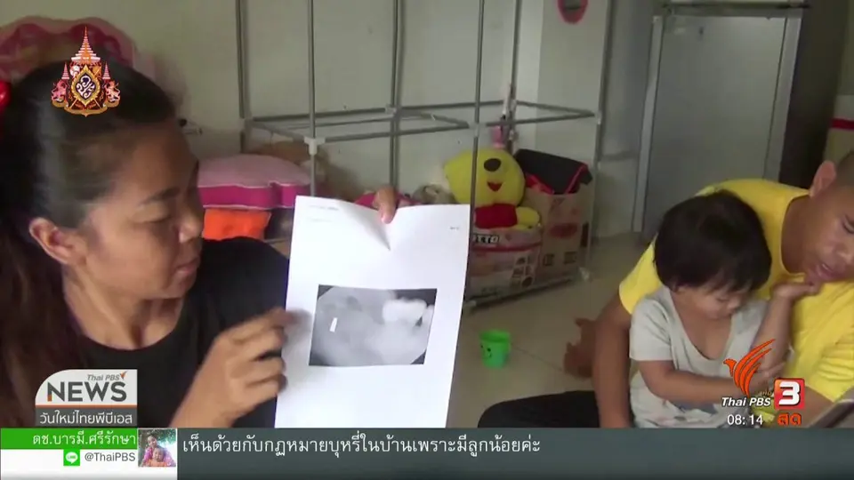 ​จับตาข่าวเด่น : คนไข้ร้องทันตแพทย์ ลืมหัวกรอฟันไว้ในเหงือกนานกว่า 5 ปี