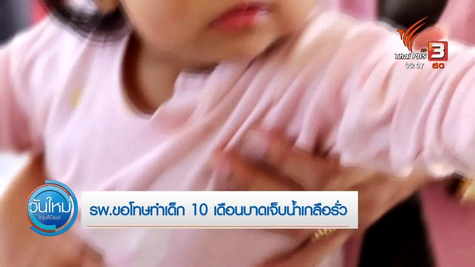 ​รพ.ขอโทษทำเด็ก 10 เดือนบาดเจ็บน้ำเกลือรั่ว