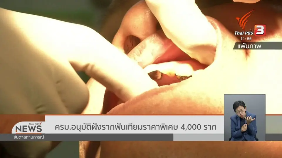 ​ครม.อนุมัติฝังรากฟันเทียมราคาพิเศษ 4,000 ราก