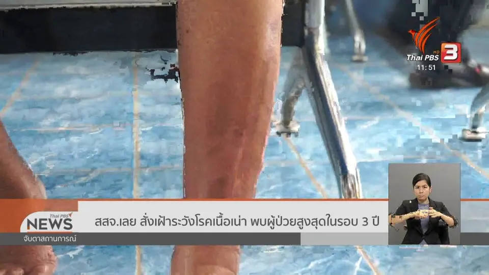 ​สสจ.เลย สั่งเฝ้าระวังโรคเนื้อเน่า พบผู้ป่วยสูงสุดในรอบ 3 ปี