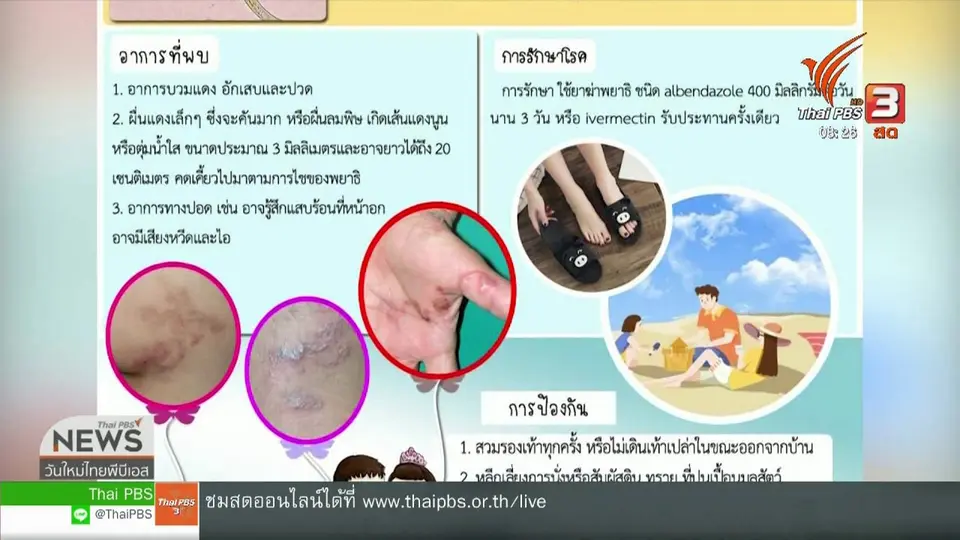 ​เกาะติดประเด็นร้อน : แพทย์โรคผิวหนัง เตือนเดินเท้าเปล่าเสี่ยงโรคพยาธิไชผิว