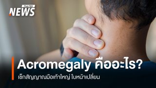 Acromegaly คืออะไร เช็กสัญญาณมือเท้าใหญ่ ใบหน้าเปลี่ยน  