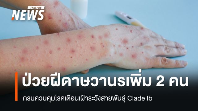 พบผู้ป่วย ฝีดาษวานรเพิ่ม 2 คน คร.เตือนเฝ้าระวังสายพันธุ์ Clade Ib
