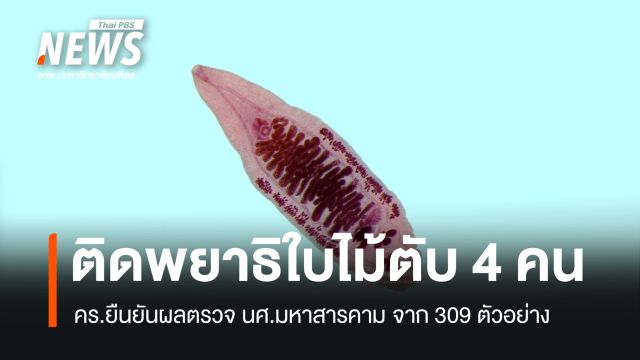 คร.เปิดผลตรวจ นศ.มหาสารคาม ติดพยาธิใบไม้ตับ 4 คน 