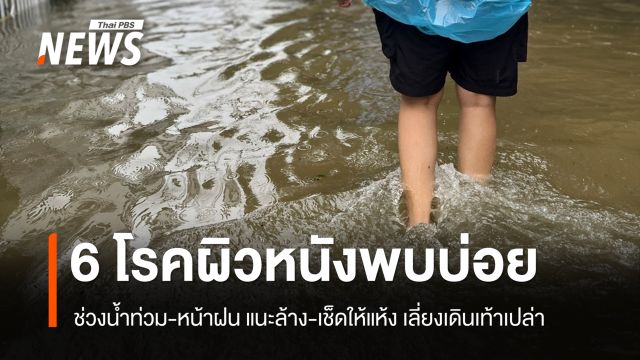 6 โรคผิวหนังพบบ่อย ช่วงน้ำท่วม-หน้าฝน แนะล้าง-เช็ดให้แห้ง เลี่ยงเดินเท้าเปล่า