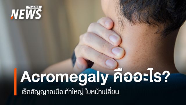 Acromegaly คืออะไร เช็กสัญญาณมือเท้าใหญ่ ใบหน้าเปลี่ยน  