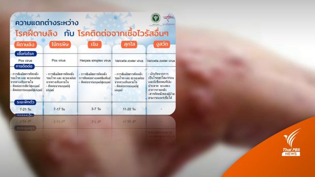 ความแตกต่าง "โรคฝีดาษลิง" กับโรคติดต่อจากเชื้อไวรัสอื่น 