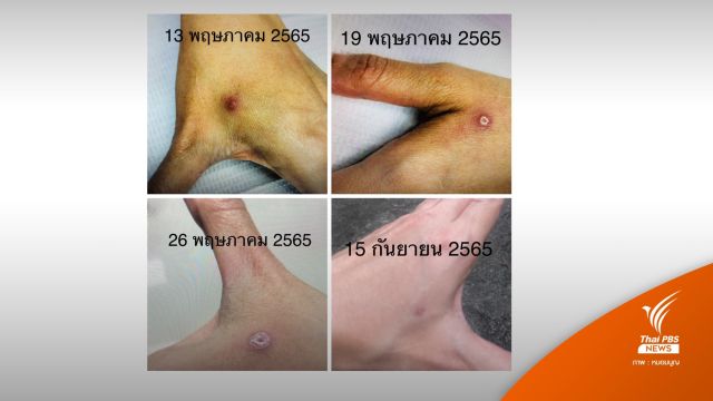 "หมอมนูญ" เตือนแมวกัด-หนามกุหลาบตำ เสี่ยงโรคสปอโรทริโคซิส