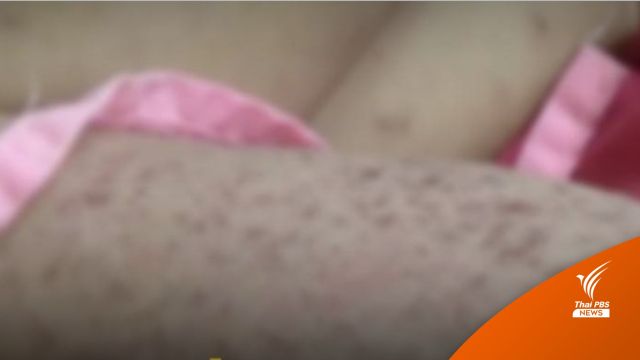 WHO จับตา “โรคหัด” เสี่ยงระบาด เหตุเด็กเล็กฉีดวัคซีนลด
