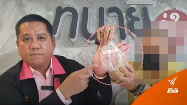 หญิง วัย 57 ปี ร้องขอความเป็นธรรม หมอลืม "ดอกสว่าน" ไว้ในขานาน 6 ปี