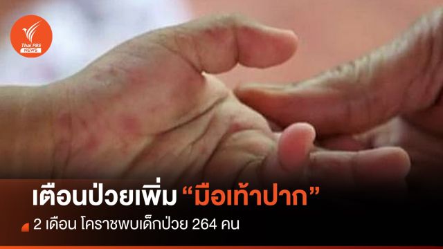 โคราช เตือน 2 เดือน เด็กป่วยโรคมือเท้าปาก 264 คน 