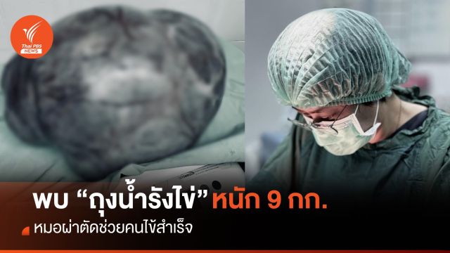 คิดว่าอ้วน ที่แท้แบก "ถุงน้ำรังไข่" หนัก 9 กก. หมอผ่าตัดสำเร็จ