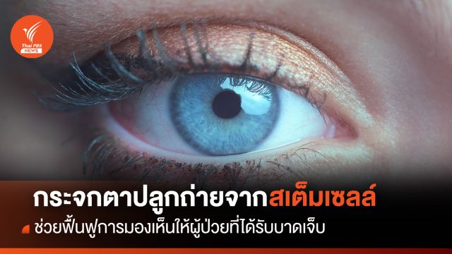 ปลูกถ่ายกระจกตาจากสเต็มเซลล์ ช่วยฟื้นฟูการมองเห็นให้ผู้ป่วยที่ได้รับบาดเจ็บ