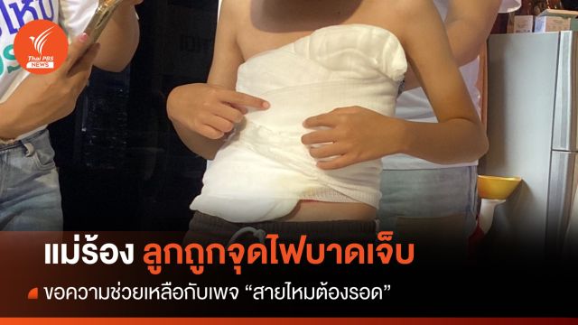 แม่เด็กชายวัย 11 ร้องลูกถูกราดแอลกอฮอล์-จุดไฟ บาดเจ็บตามตัว