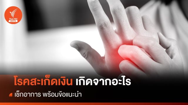 29 ตุลาคม ของทุกปี "วันสะเก็ดเงินโลก" โรคผิวหนังที่ควรรู้จัก