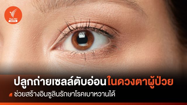 การปลูกถ่ายเซลล์ตับอ่อนในดวงตาผู้ป่วย ช่วยสร้างอินซูลินรักษาโรคเบาหวานได้