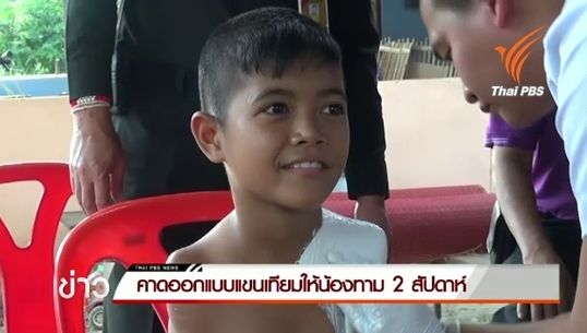 รพ.ทหารผ่านศึกคาดใช้เวลา 2 สัปดาห์ออกแบบแขนเทียมให้"น้องทาม"