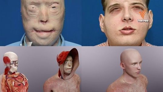 แพทย์สหรัฐฯ ผ่าตัด 26 ชม. สวมใบหน้าผู้บริจาคให้อาสาสมัครดับเพลิงถูกไฟคลอกสำเร็จ 