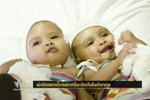 แพทย์อังกฤษผ่าตัดแยกเด็กแฝดศีรษะติดกันสำเร็จ