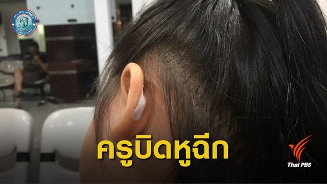แม่โร่แจ้งความ ครูพี่เลี้ยงบิดหูลูก  5 ขวบจนเป็นแผลฉีก