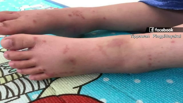เฝ้าระวัง "โรคฮีน็อค" พบบ่อยในเด็ก มีผื่น-ปวดขา-ถ่ายเหลว 