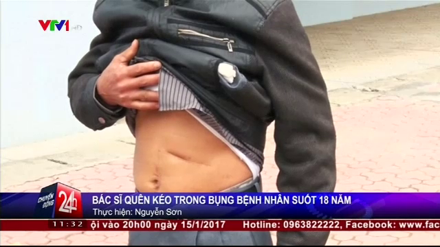 กรรไกรผ่าตัดอยู่ในท้องหนุ่มเวียดนาม 18 ปี คาดแพทย์ลืม 
