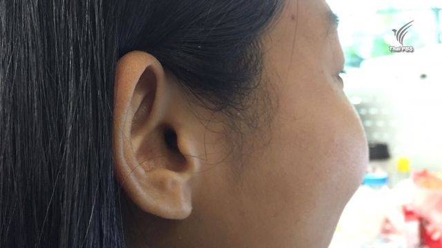ทำความรู้จัก "โรคน้ำในหูไม่เท่ากัน " 