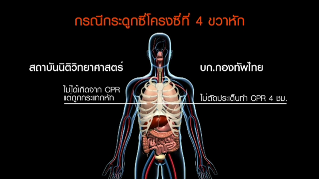  ข้อสังเกตคำแถลงกองทัพ "เมย" ซี่โครงหักมาจากทำ CPR 4  ชม.