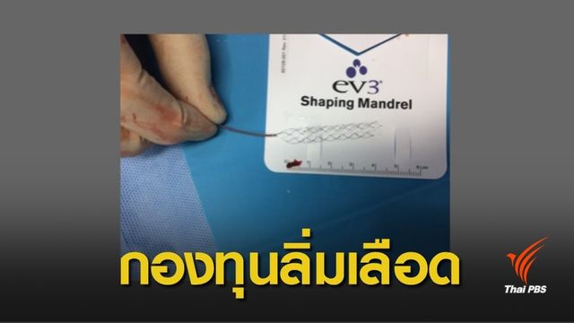  แพทย์เผยวิธีลากสวนลิ่มเลือด ช่วยผู้ป่วยโรคหลอดเลือดสมองตีบ