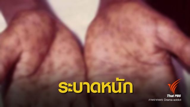โลกโซเชียลแห่ให้ข้อมูล "ซิฟิลิส" ระบาด ไม่รีบรักษาอาจถึงตาย