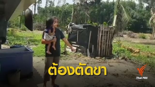 หญิงอายุ 24 ปี ถูกสุนัขกัดต้องตัดขา 