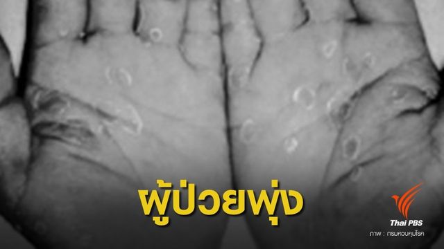 น่าห่วง! 6 เดือน ยอดผู้ป่วย "ซิฟิลิส" พุ่ง 3,752 คน 
