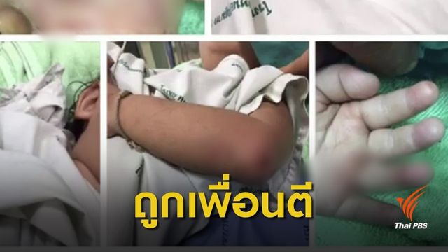 ครูโคราช ระบุ เพื่อนทำร้าย ดญ. 2 ขวบ 