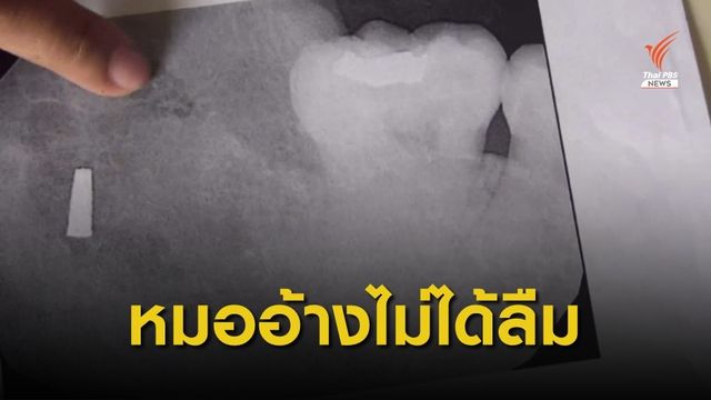 หมอตากใบ ยืนยันไม่ได้ลืม "หัวกรอฟัน" ในปากคนไข้