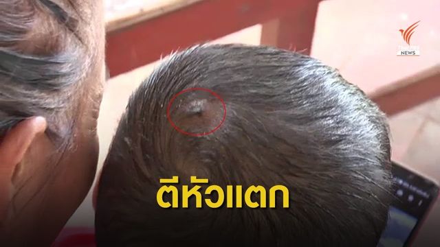 ผู้ปกครองยืนยันเอาเรื่องครูบุรีรัมย์ตีเด็ก ป.1 หัวแตก