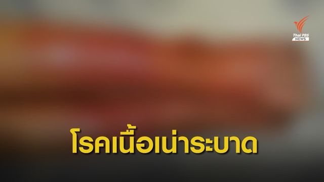 รพ.น่าน เตือนระวัง "โรคเนื้อเน่า" หลังพบผู้ป่วย 1 เดือน 25 คน