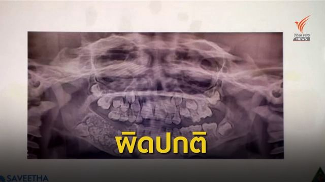 ถอนฟันเด็กในอินเดียกว่า 500 ซี่