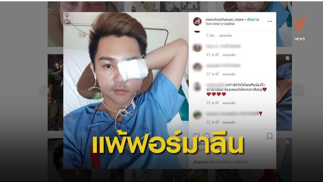 เตือนคนแพ้ "ฟอร์มาลีน" สารแช่สดอมตะในอาหาร 
