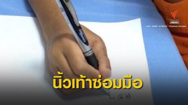 สุดทึ่ง! หมอกระดูกใช้ “นิ้วเท้า” สร้าง “นิ้วมือ”สำเร็จ