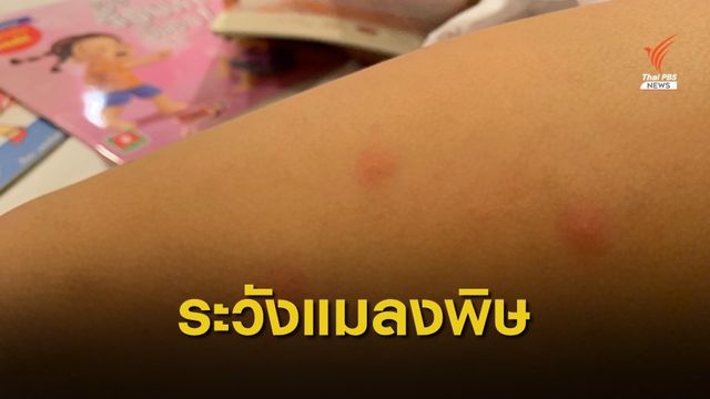 เตือนแมลงมีพิษกัดต่อยอันตรายถึงชีวิต ให้รีบพบแพทย์ทันที