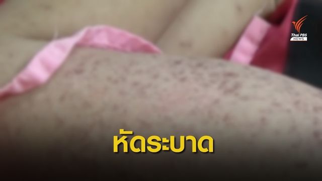 สธ.เผยผู้ป่วยหัดเพิ่มขึ้นทั่วโลก แนะพาเด็กฉีดวัคซีนป้องกัน