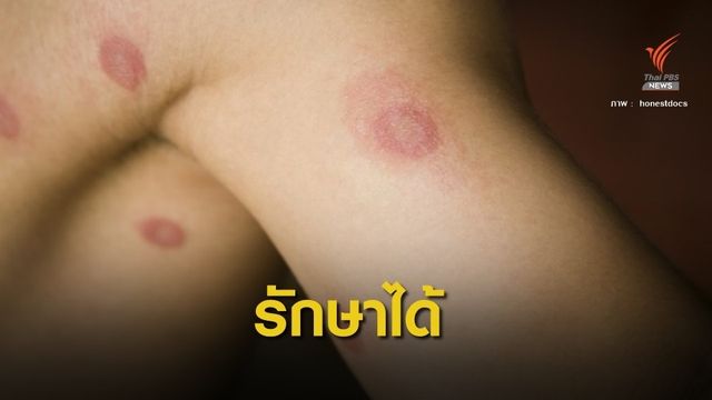  "โรคผื่นรูปเหรียญ" ไม่น่ากลัวรักษาหายขาดได้