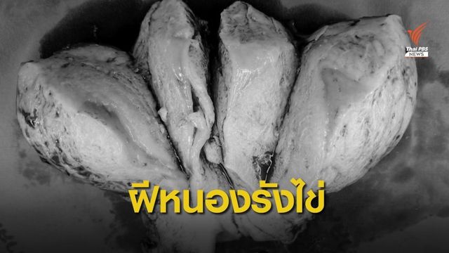 สัญญาณเตือน ปวดท้องน้อยบ่อย-มีไข้ เสี่ยงเป็นฝีหนองในรังไข่