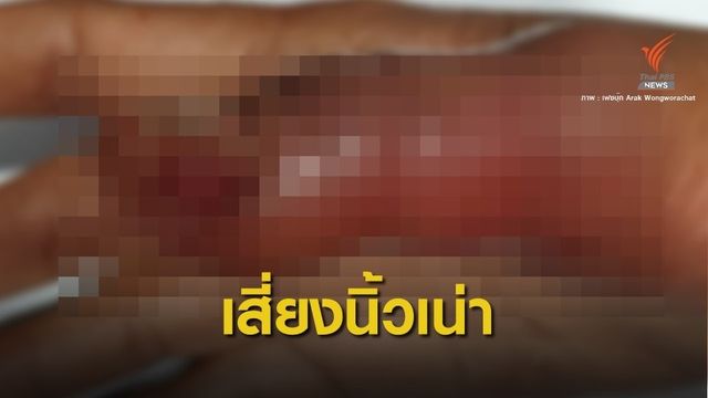 หมอเตือนเสริมสวย "ต่อเล็บ" เสี่ยงติดเชื้อเน่า  