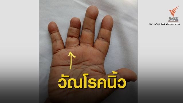 หมอเตือน "วัณโรคกระดูกลงนิ้วมือ" เจอเคสแรกในรอบ 15 ปี 