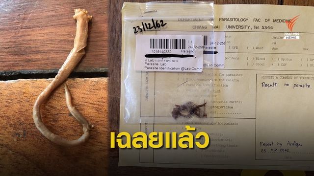 เฉลย! ปมหางปริศนาในชามก๋วยเตี๋ยว ที่แท้ "เอ็นขั้วตับหมู"