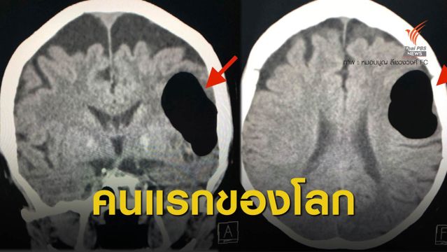 "หมอมนูญ" เปิดเคสเอามือปิดปาก-จมูกขณะจามทำ "ลมเข้าสมอง" 