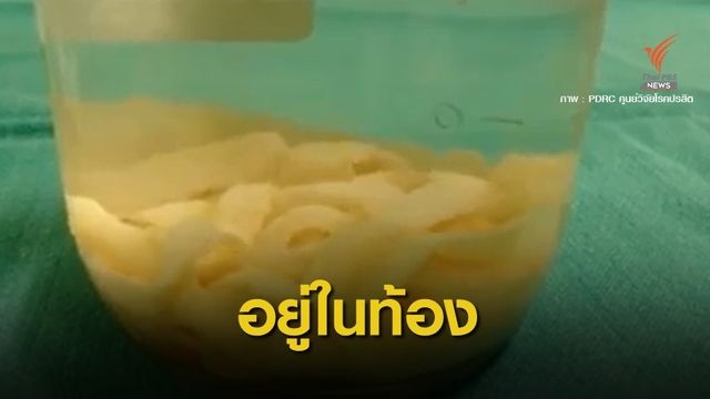 ช็อก! หมอโพสต์คลิปเตือนดึงพยาธิตืดหมูออกทางปาก